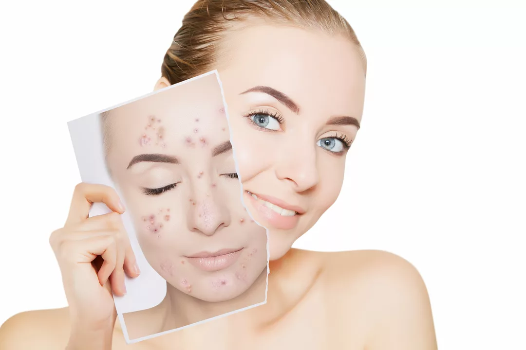 Isotretinoin and the Future of Acne Treatments